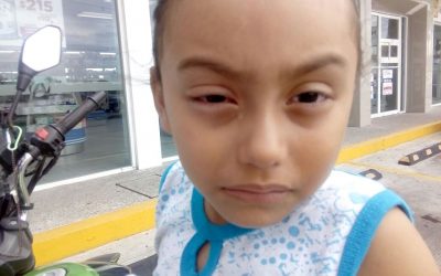 Buscan prevenir epidemia de Conjuntivitis