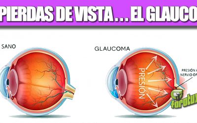 NO PIERDAS DE VISTA… EL GLAUCOMA